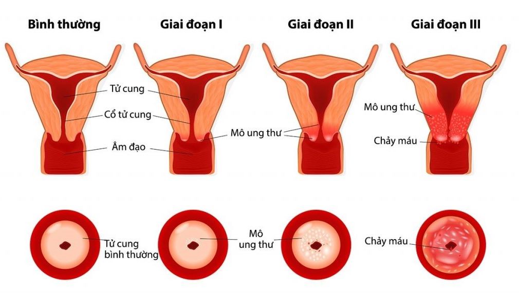 Tầm soát sớm ung thư cổ tử cung